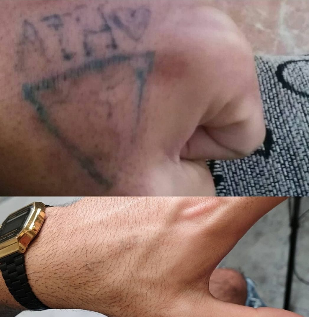 alex_beketov — Tattoo removal, Barcelona — 2