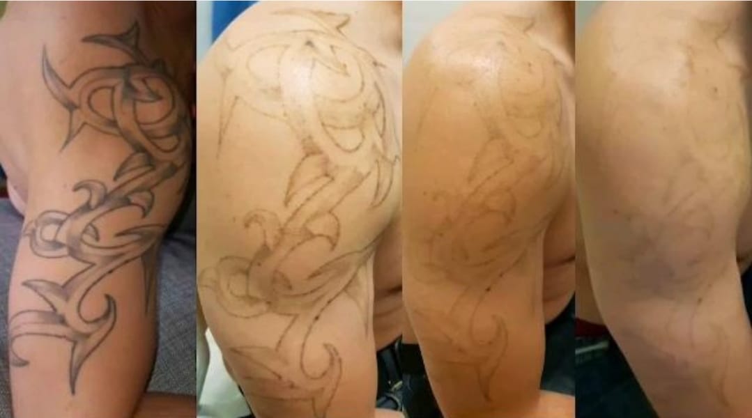 alex_beketov — Tattoo removal, Barcelona — 3