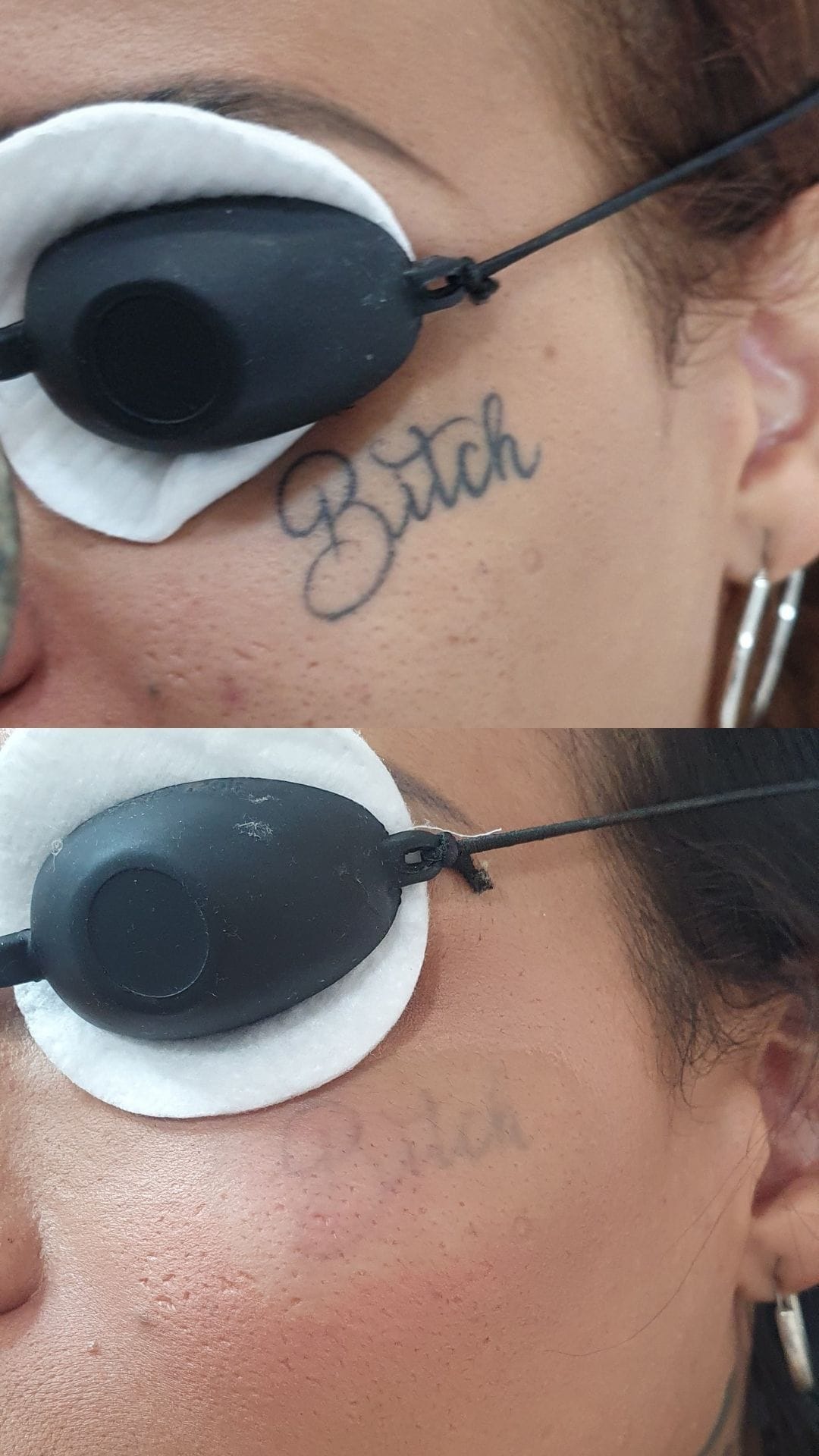 alex_beketov — Tattoo removal, Barcelona — 4