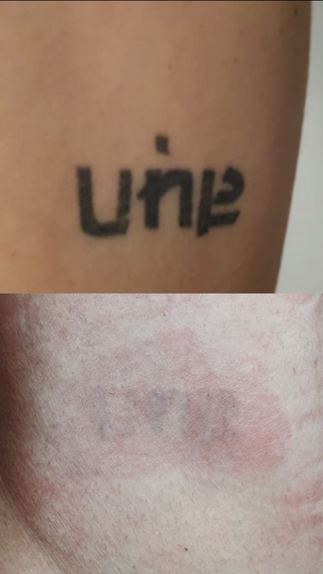 alex_beketov — Tattoo removal, Barcelona — 5