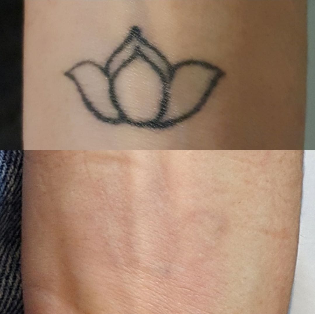 alex_beketov — Tattoo removal, Barcelona — 6