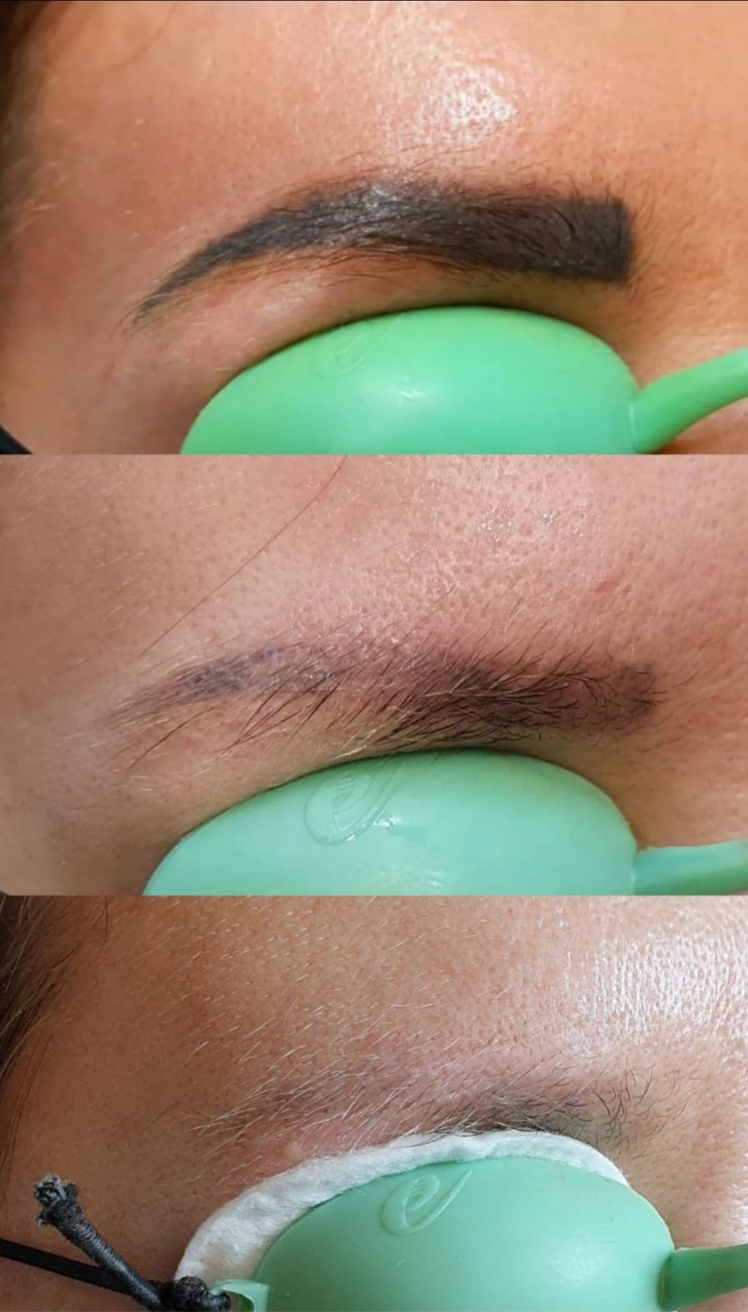 alex_beketov — Tattoo removal, Barcelona — 7